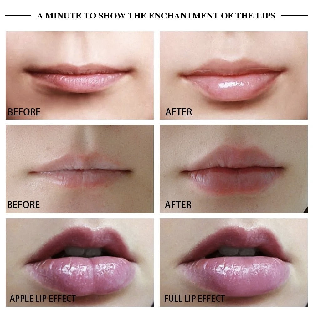 Lip Augmentation Device